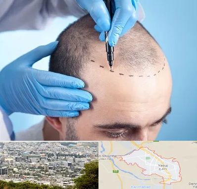 دکتر کاشت مو در یاسوج