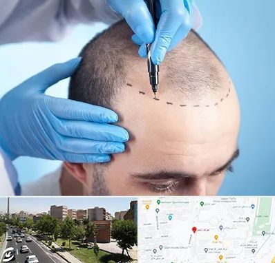 دکتر کاشت مو در شهرک آزمایش 