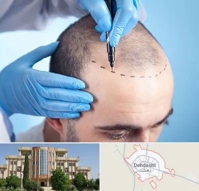 دکتر کاشت مو در دهدشت