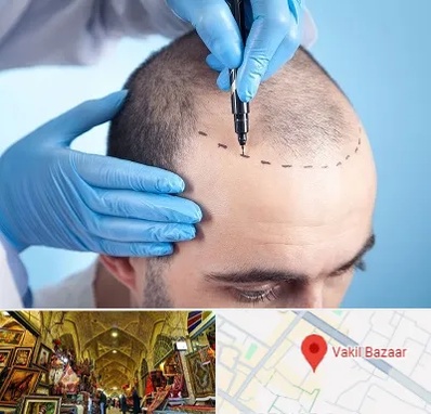 دکتر کاشت مو در بازار وکیل شیراز