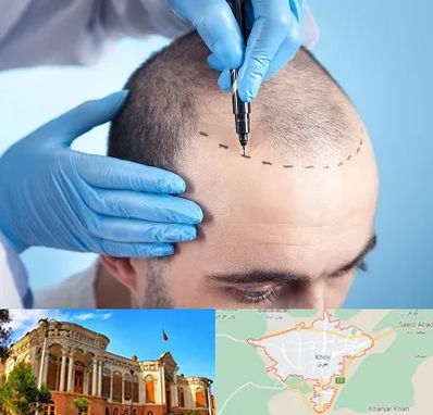 دکتر کاشت مو در خوی