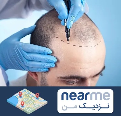 دکتر کاشت مو در نزدیک من