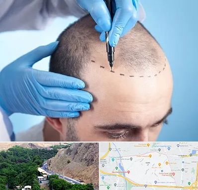 دکتر کاشت مو در کن 