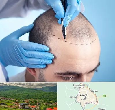 دکتر کاشت مو در آمل
