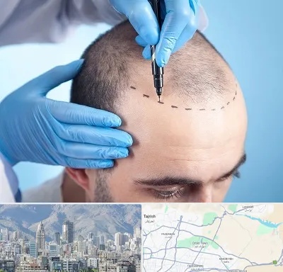 دکتر کاشت مو در شمال شرق تهران