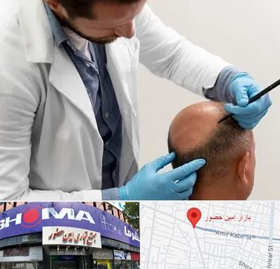 کاشت مو به روش تکثیری در امین حضور