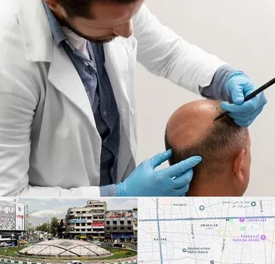 کاشت مو به روش تکثیری در مرکز تهران