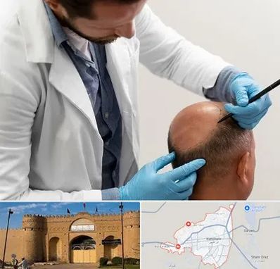 کاشت مو به روش تکثیری در ایرانشهر