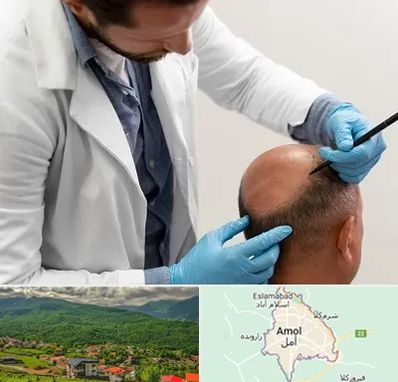 کاشت مو به روش تکثیری در آمل