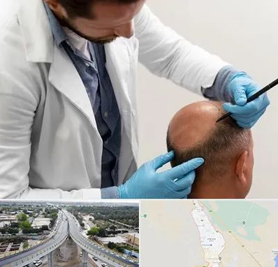 کاشت مو به روش تکثیری در اندیمشک