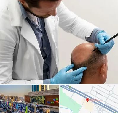 کاشت مو به روش تکثیری در لاله پارک تبریز