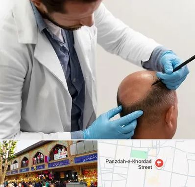 کاشت مو به روش تکثیری در 15 خرداد