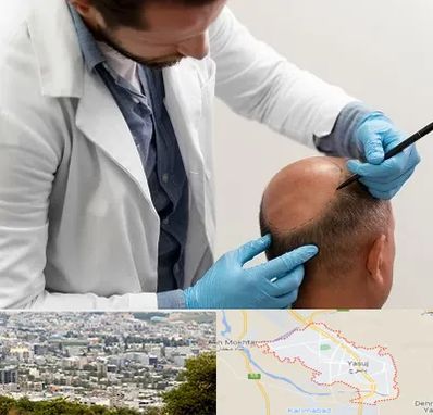 کاشت مو به روش تکثیری در یاسوج