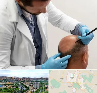 کاشت مو به روش تکثیری در شهریار