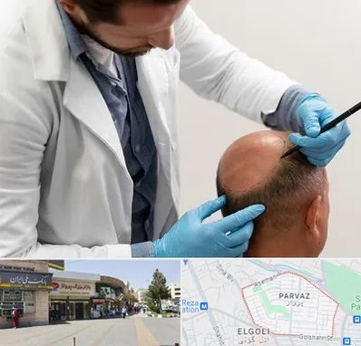 کاشت مو به روش تکثیری در پرواز تبریز