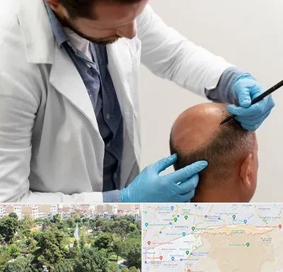 کاشت مو به روش تکثیری در منطقه 13 تهران 