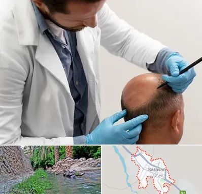 کاشت مو به روش تکثیری در سراوان