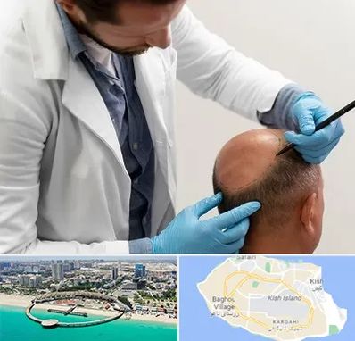 کاشت مو به روش تکثیری در کیش