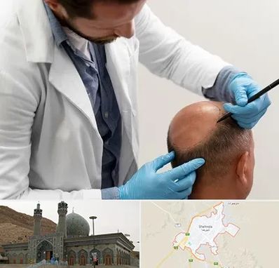 کاشت مو به روش تکثیری در شهرضا