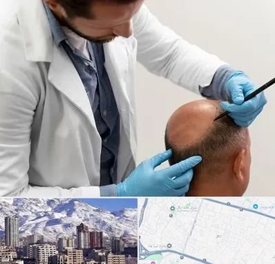 کاشت مو به روش تکثیری در ازگل