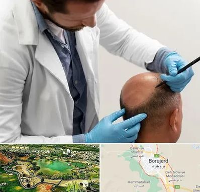 کاشت مو به روش تکثیری در بروجرد