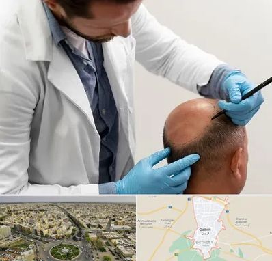 کاشت مو به روش تکثیری در قزوین