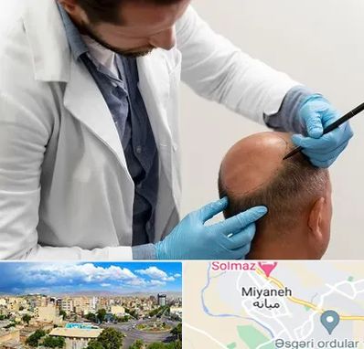 کاشت مو به روش تکثیری در میانه