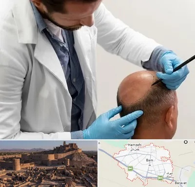 کاشت مو به روش تکثیری در بم