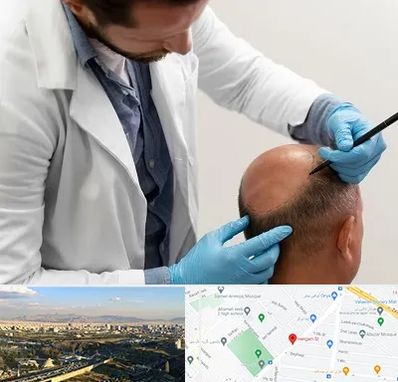 کاشت مو به روش تکثیری در هنگام 