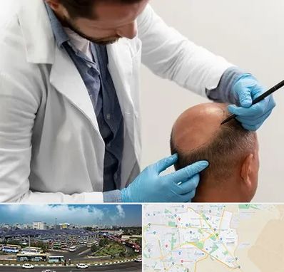 کاشت مو به روش تکثیری در منطقه 15 تهران 