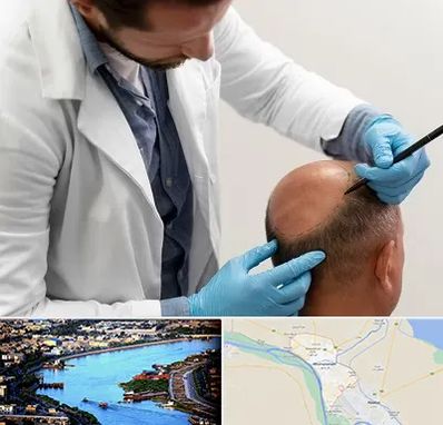 کاشت مو به روش تکثیری در خرمشهر