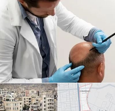 کاشت مو به روش تکثیری در اسکندری