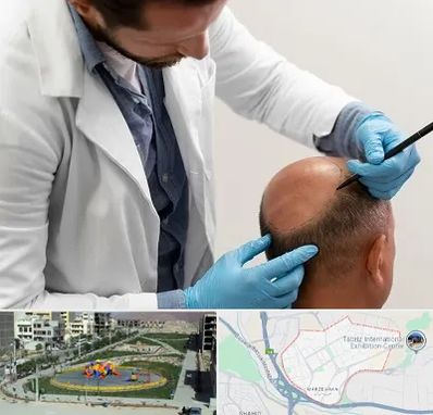 کاشت مو به روش تکثیری در مرزداران تبریز