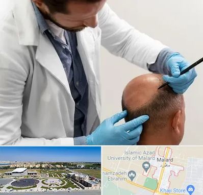 کاشت مو به روش تکثیری در ملارد