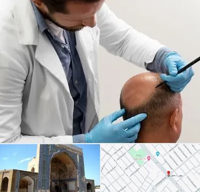 کاشت مو به روش تکثیری در مصلی مشهد