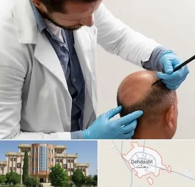 کاشت مو به روش تکثیری در دهدشت