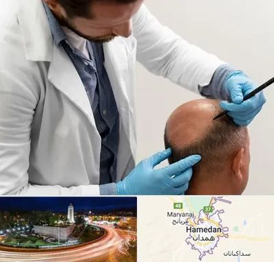 کاشت مو به روش تکثیری در همدان