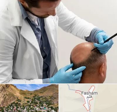 کاشت مو به روش تکثیری در فشم