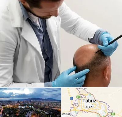 کاشت مو به روش تکثیری در تبریز