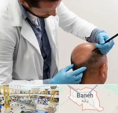 کاشت مو به روش تکثیری در بانه