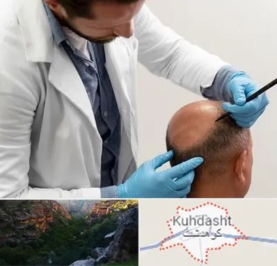 کاشت مو به روش تکثیری در کوهدشت