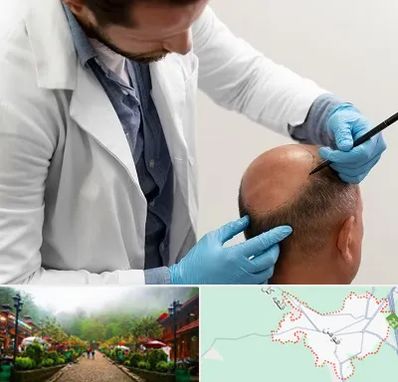 کاشت مو به روش تکثیری در فومن
