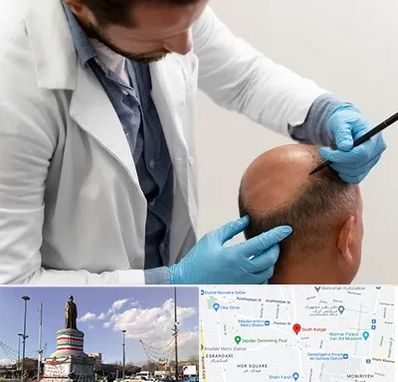 کاشت مو به روش تکثیری در کارگر جنوبی 