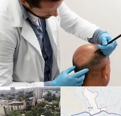 کاشت مو به روش تکثیری در اوین