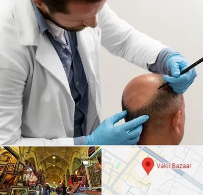 کاشت مو به روش تکثیری در بازار وکیل شیراز