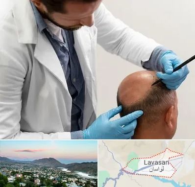 کاشت مو به روش تکثیری در لواسان