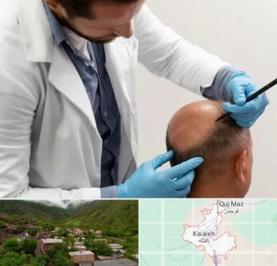 کاشت مو به روش تکثیری در کلاله