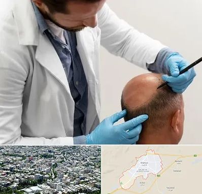 کاشت مو به روش تکثیری در شاهرود