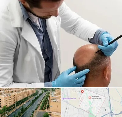 کاشت مو به روش تکثیری در فاز سه اندیشه
