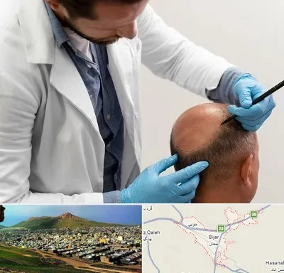 کاشت مو به روش تکثیری در بیجار